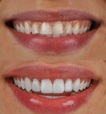 خدمات ایمپلنت یک روزه با روکش کامپوزیت دندان